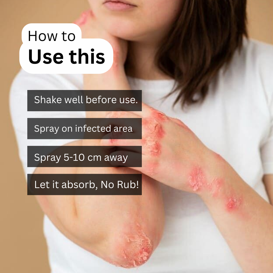 ItchXpert Herbal Anti Fungal Spray - (Buy 1 Get 1 FREE🔥🔥)