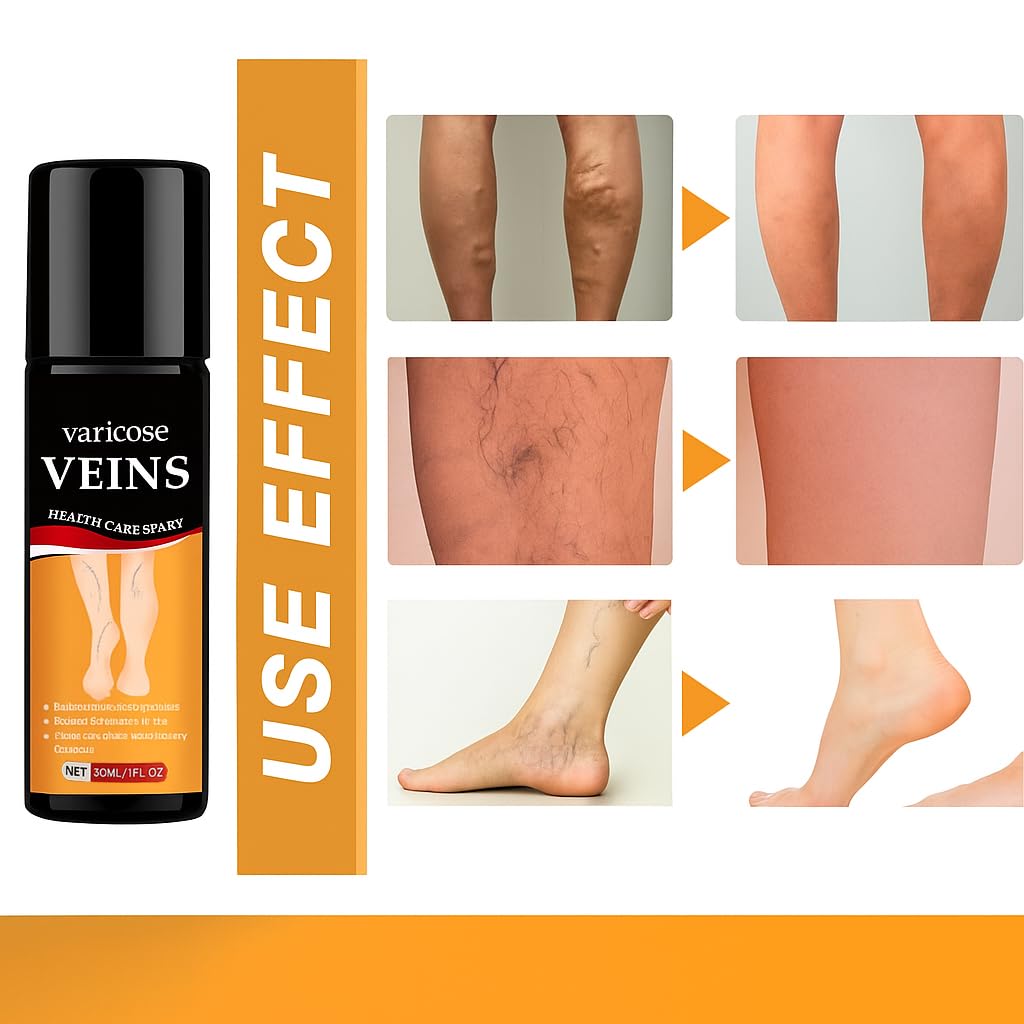 Turmeric Varicose Veins Relief Spray (நரம்பு சுருட்டல் நிவாரணி)