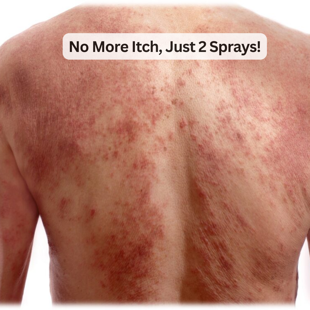 ItchXpert Herbal Anti Fungal Spray - (Buy 1 Get 1 FREE🔥🔥)