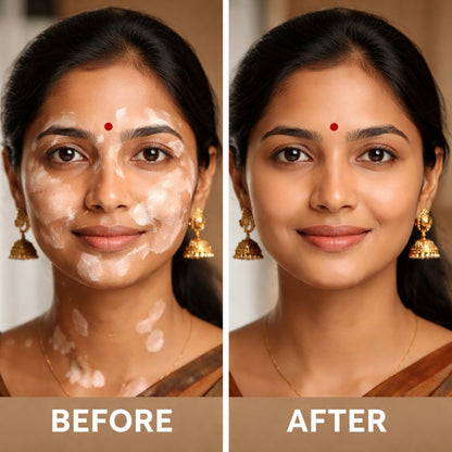 VitiGO™ - Vitiligo தீர்வு (⚡Buy 1 Get 1 FREE⚡)