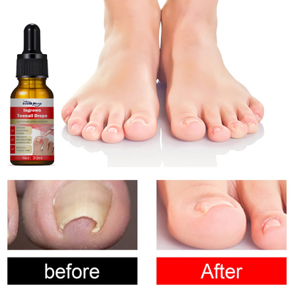 Toenail Drops Repair Oil (1+1 FREE🔥) - நகம் சரியாகும்!
