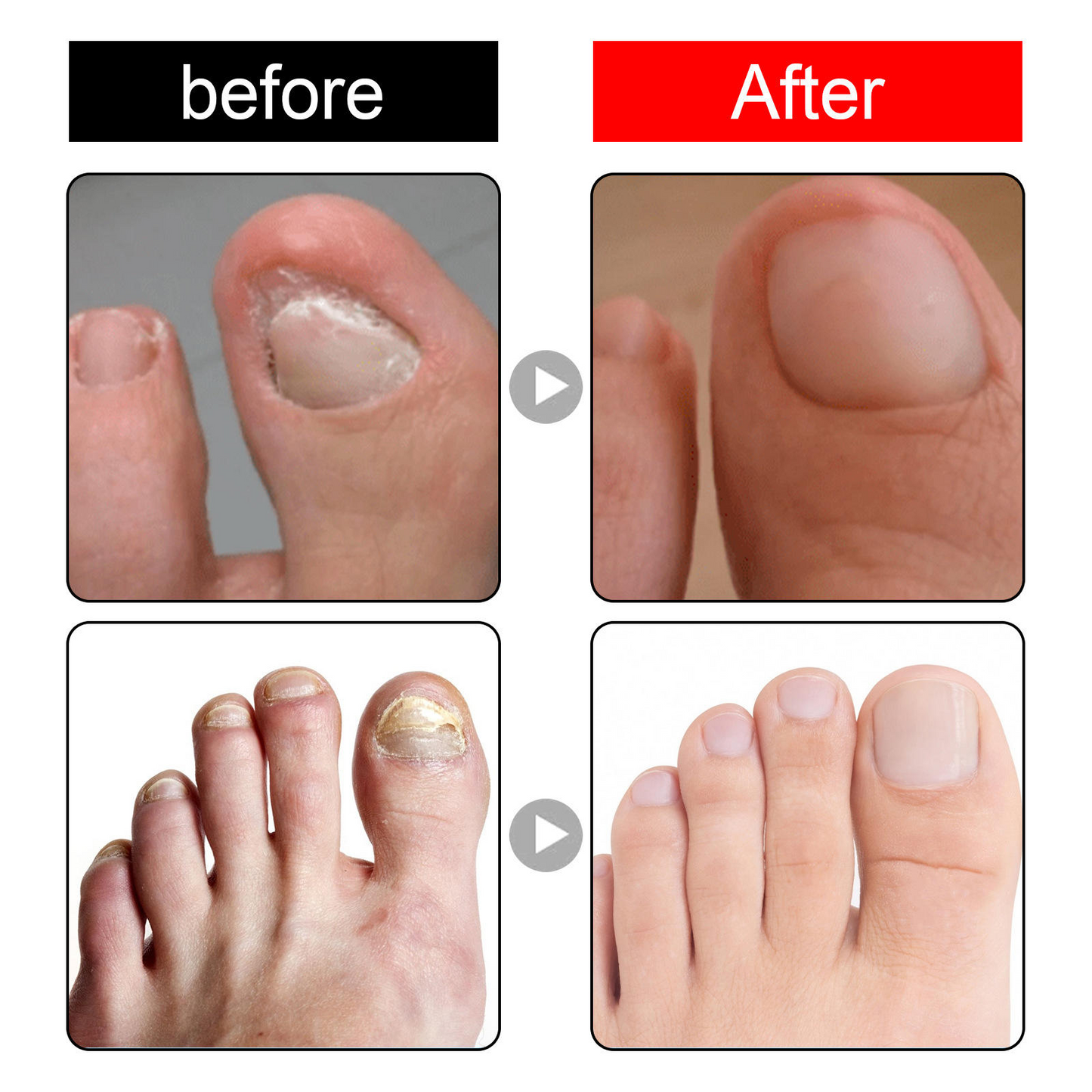 Toenail Drops Repair Oil (1+1 FREE🔥) - நகம் சரியாகும்!