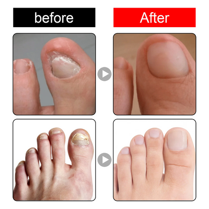 Toenail Drops Repair Oil (1+1 FREE🔥) - நகம் சரியாகும்!