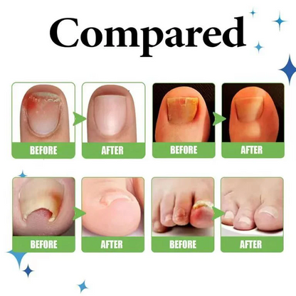 Anti Paronychia Herbal Relief Oil 🌿-(🔥 BUY 1 GET 1 FREE )