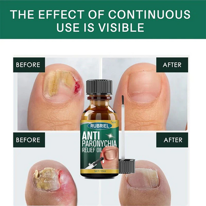 Anti Paronychia Herbal Relief Oil 🌿-(🔥 BUY 1 GET 1 FREE )