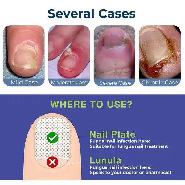 Anti Paronychia Herbal Relief Oil 🌿-(🔥 BUY 1 GET 1 FREE )