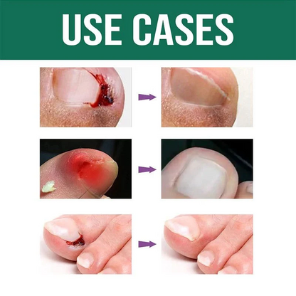 Anti Paronychia Herbal Relief Oil 🌿-(🔥 BUY 1 GET 1 FREE )