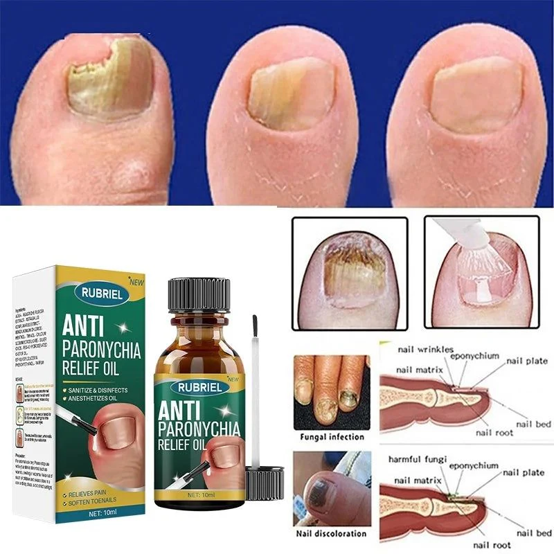 Anti Paronychia Herbal Relief Oil 🌿-(🔥 BUY 1 GET 1 FREE )