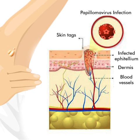Warts & Tags Remover Roll On