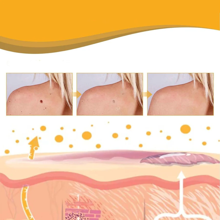 Bee Venom Wart & Skin Tag Remover Spray -(Buy 1 Get 1 FREE🔥🔥)